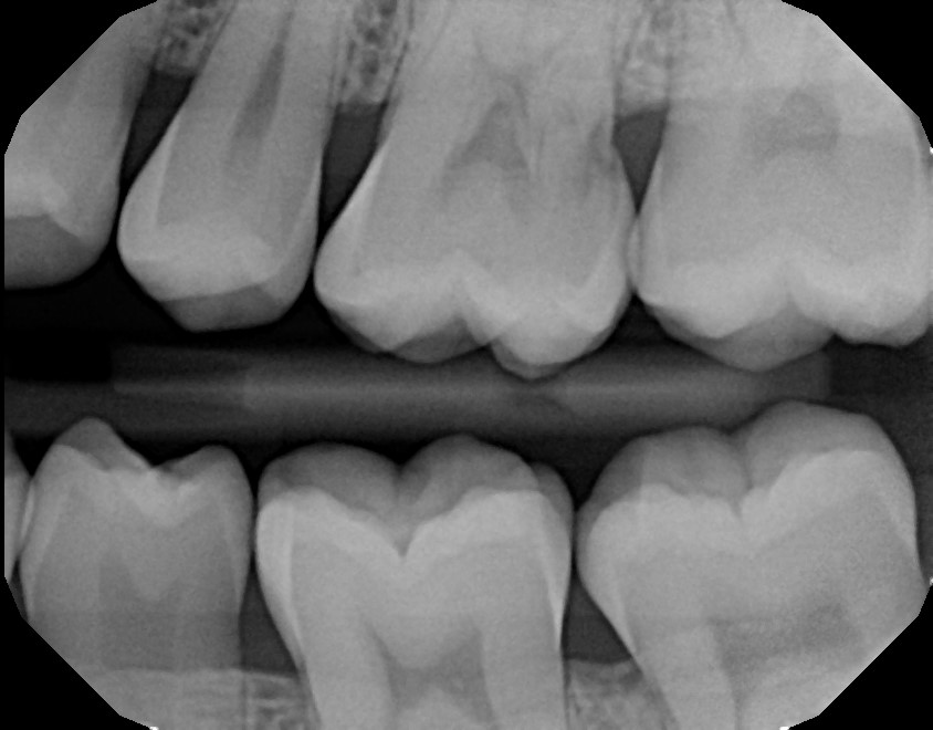 xrays of my teeth 1