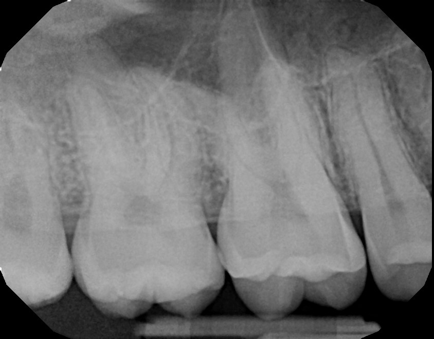 xrays of my teeth 2
