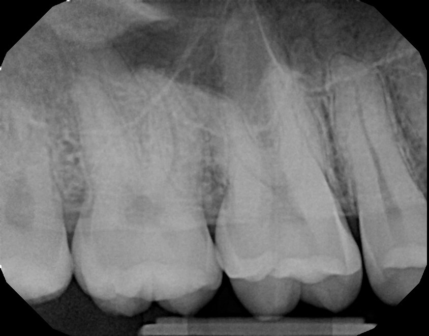 xrays of my teeth 3