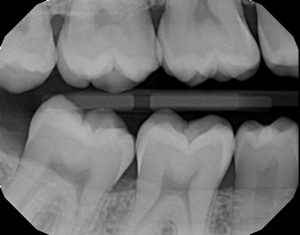 xrays of my teeth 5