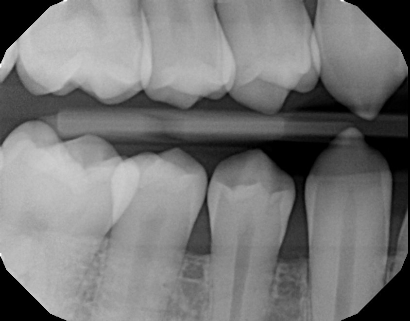 xrays of my teeth 6