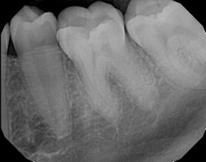 xrays of my teeth 10