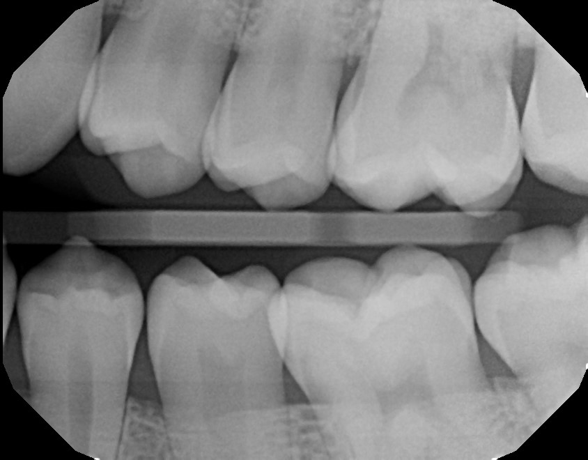 xrays of my teeth 14