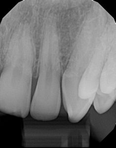 xrays of my teeth 15