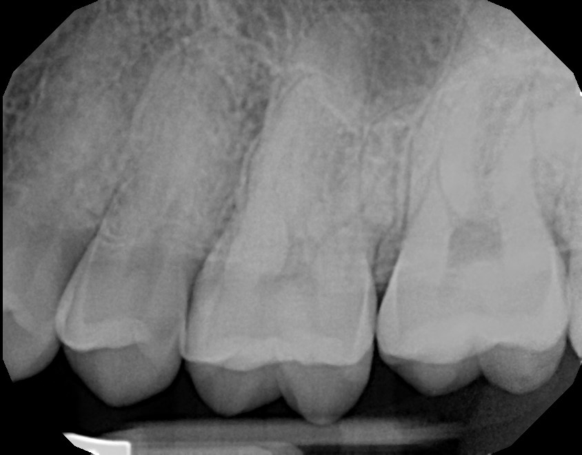 xrays of my teeth 18
