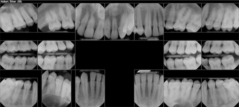 july 2018 teeth x-rays