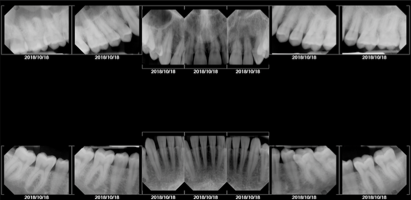 ethan hulbert professional bone xray model dental teeth