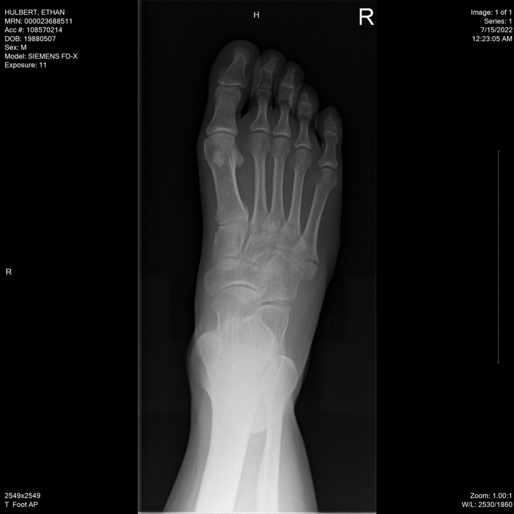 ethan hulbert right foot bones x-ray above reset imaging view