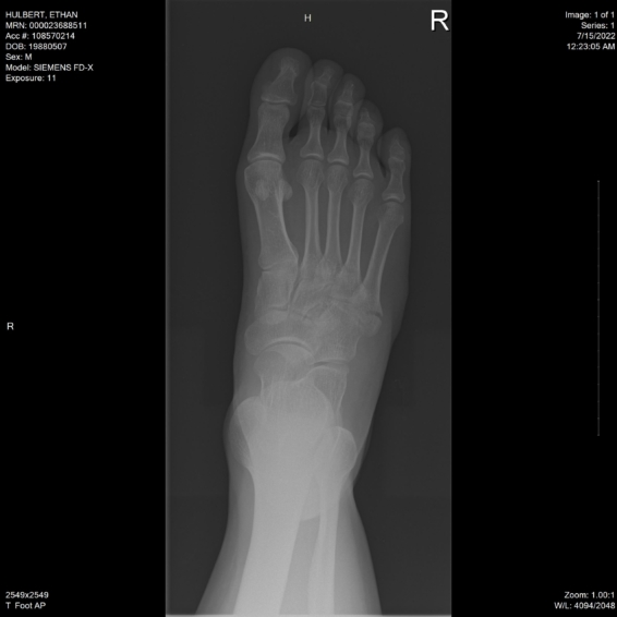 ethan hulbert right foot bones x-ray above auto view