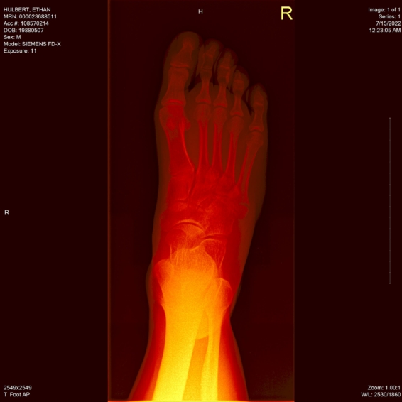ethan hulbert right foot bones x-ray above red hot metal view