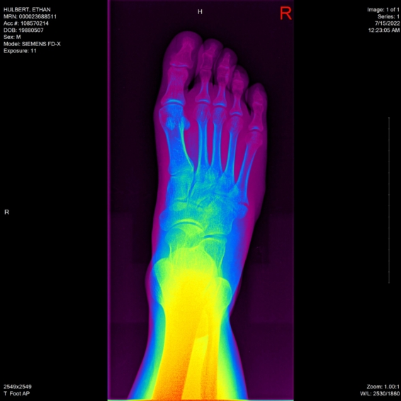 ethan hulbert right foot bones x-ray above rainbow view