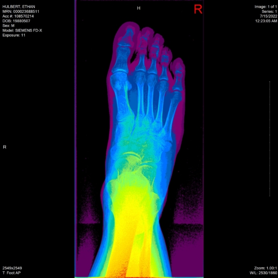 ethan hulbert right foot bones x-ray above rainbow16 view