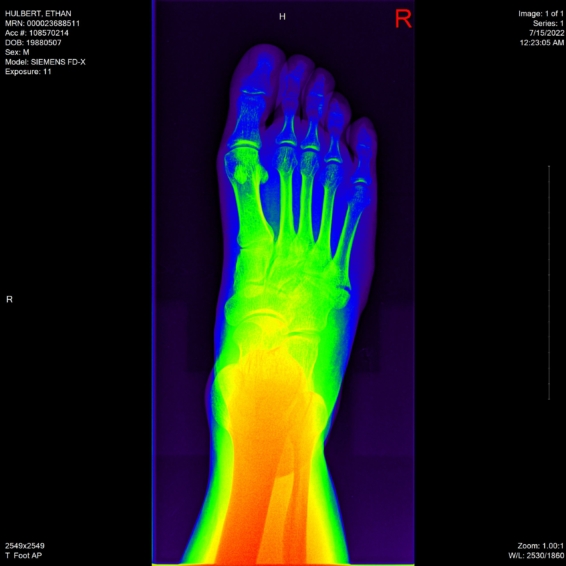 ethan hulbert right foot bones x-ray above rainbow65 mode