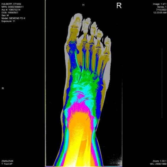 ethan hulbert right foot bones x-ray above bronson view