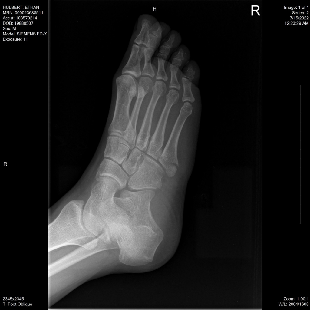 ethan foot x-ray oblique angle black white reset default