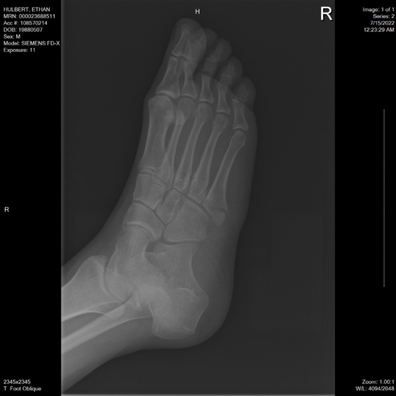 ethan foot x-ray oblique angle black and white auto low contrast