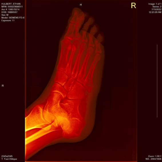 ethan foot x-ray oblique angle red hot metal view