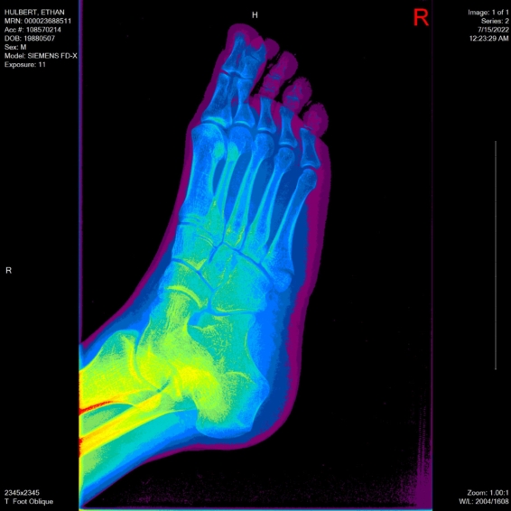 ethan foot x-ray oblique angle rainbow16 view