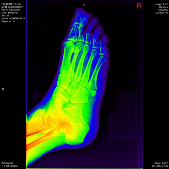 ethan foot x-ray oblique angle rainbow65 view