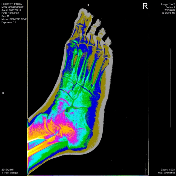 ethan foot x-ray oblique angle bronson view