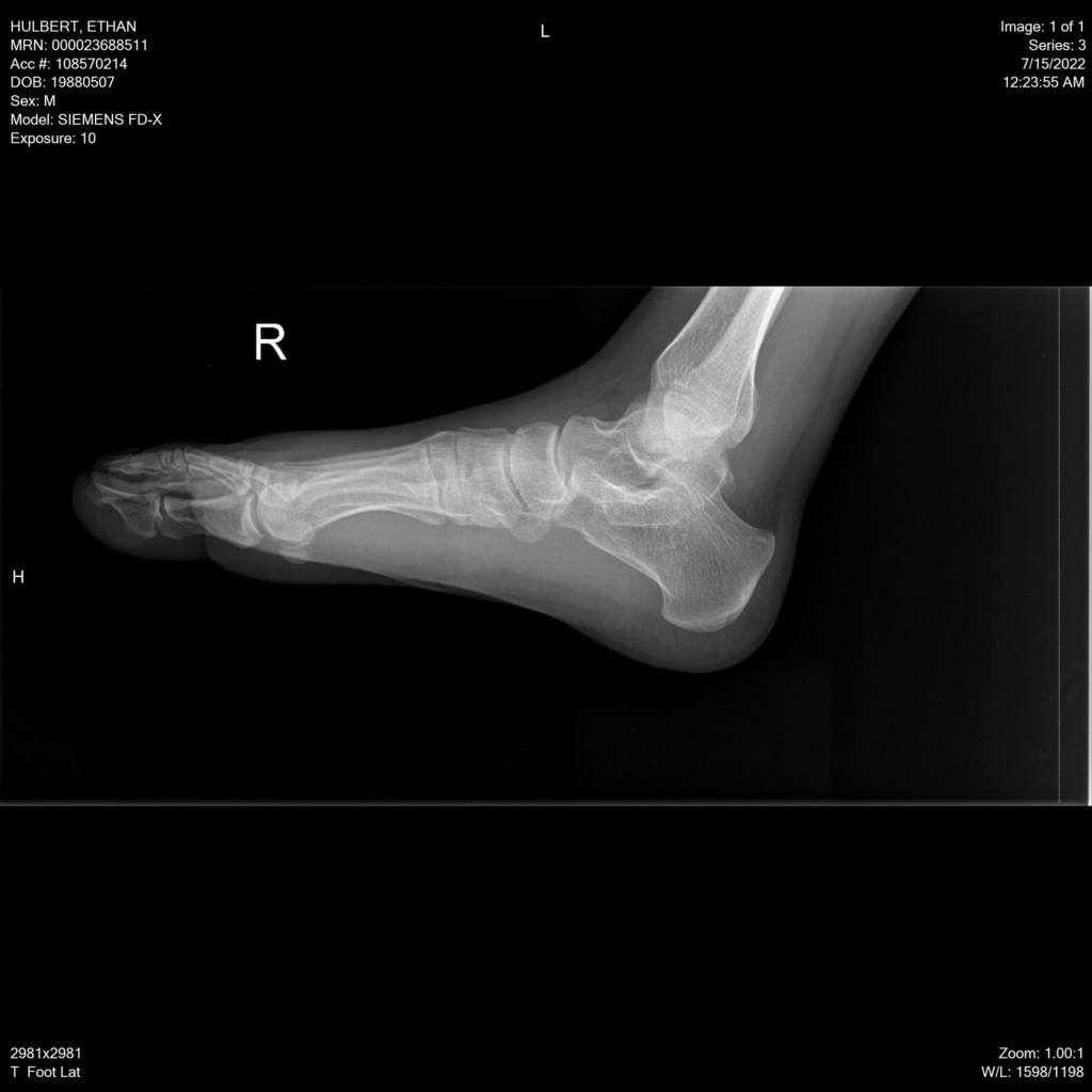 ethan hulbert feet toes bones x-ray side lateral default reset BW mode