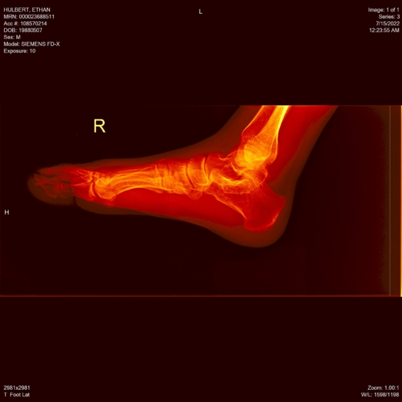 ethan hulbert feet toes bones x-ray side lateral hot metal red orange view