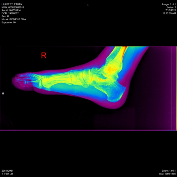 ethan hulbert feet toes bones x-ray side lateral rainbow view