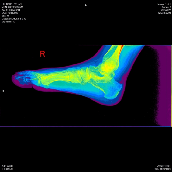 ethan hulbert feet toes bones x-ray side lateral rainbow16 view