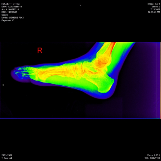 ethan hulbert feet toes bones x-ray side lateral rainbow65 view