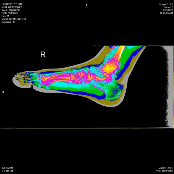 ethan hulbert feet toes bones x-ray side lateral bronson view