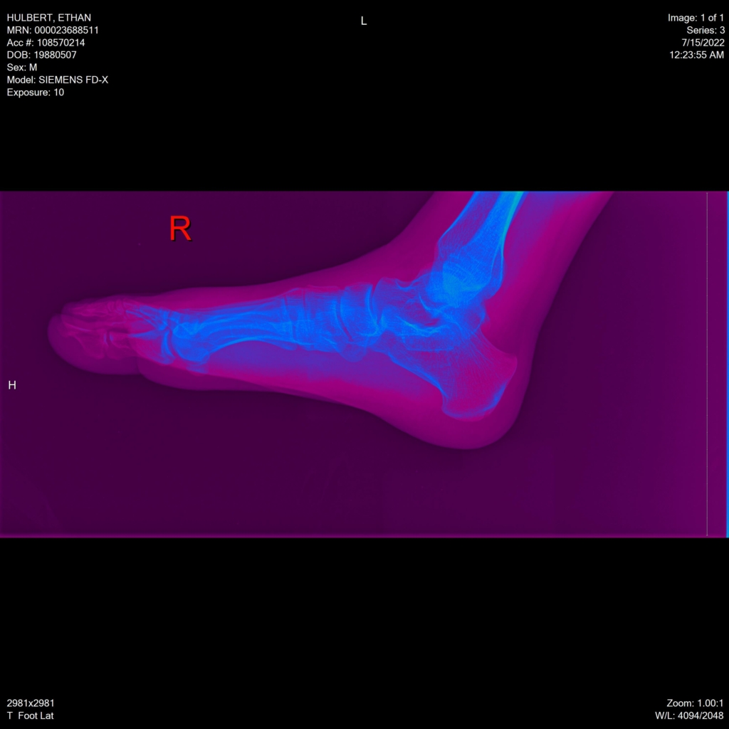 ethan hulbert feet toes bones x-ray side lateral auto low contrast rainbow purple