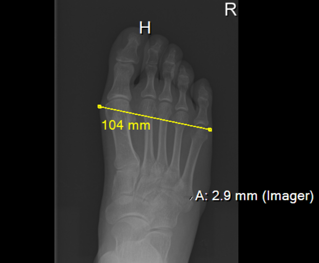 gear view x-ray software measurement of my foot