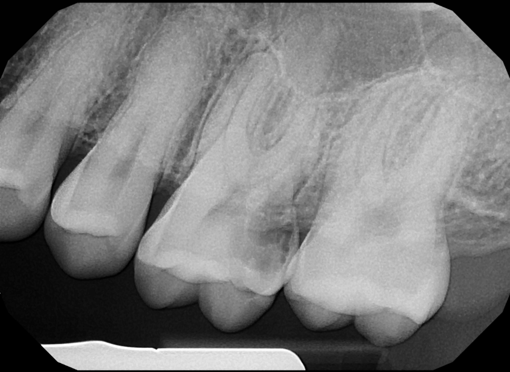 january 2024 sota x-ray export ethan hulbert's root canal teeth