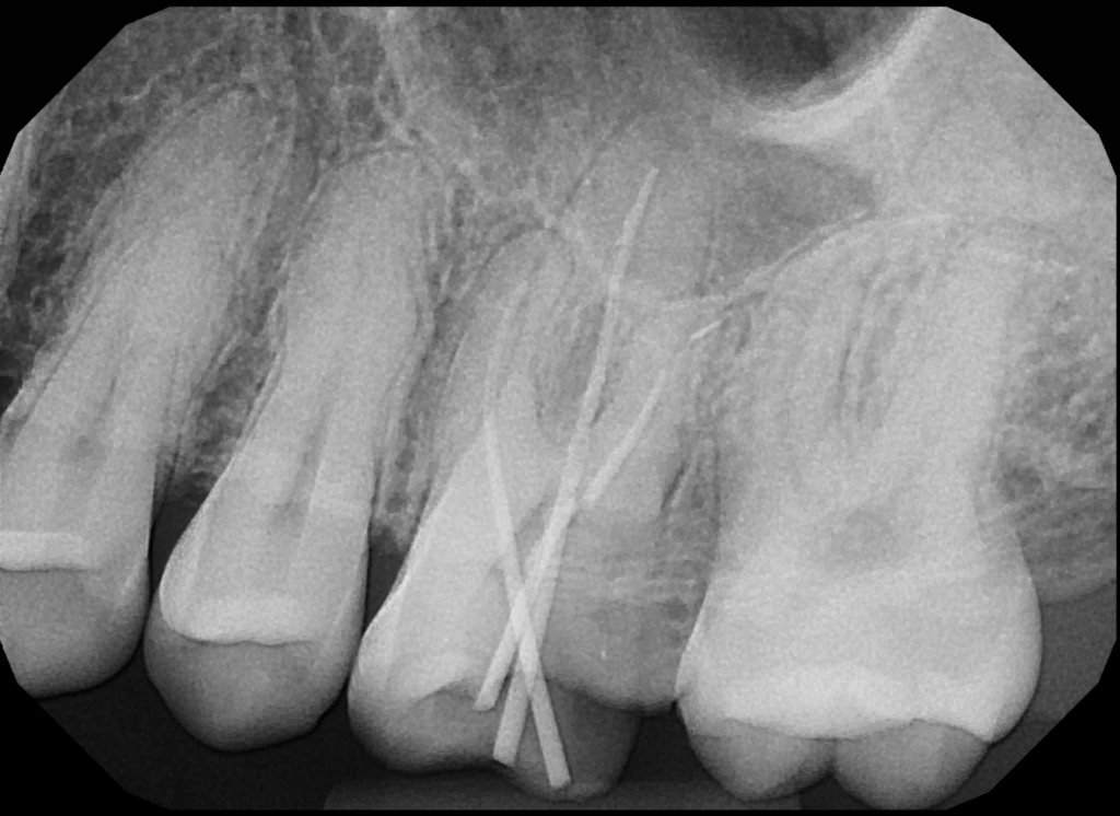 jan 2024 second x-ray of back left teeth with metal wires stuck through tooth
